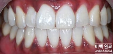 미백 후